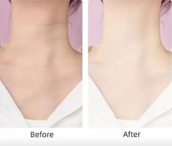 Masajeador de Estiramiento Facial para el Cuello Rosa